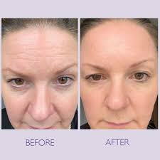 سرم ضد چروک رتینول 1% اوردینری 